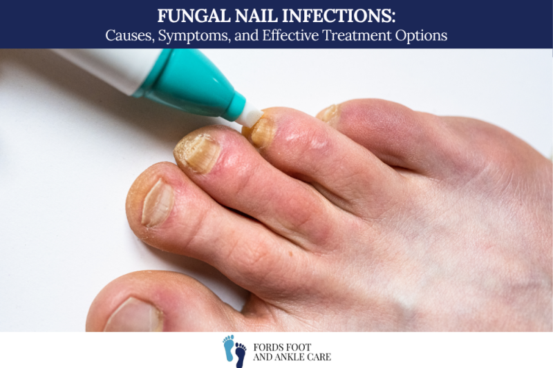 Fungal Nail Infections: Causes, Symptoms, and Effective Treatment Options
