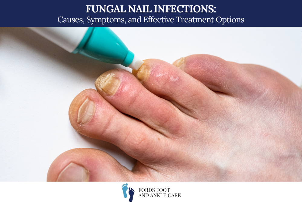 Fungal Nail Infections: Causes, Symptoms, and Effective Treatment Options
